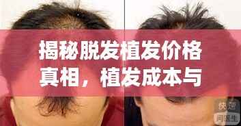 揭秘脱发植发价格真相，植发成本与最佳方案选择全解析